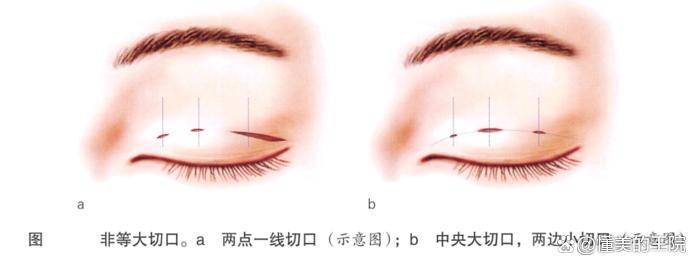 最新重睑技术｜前沿双眼皮整形技术